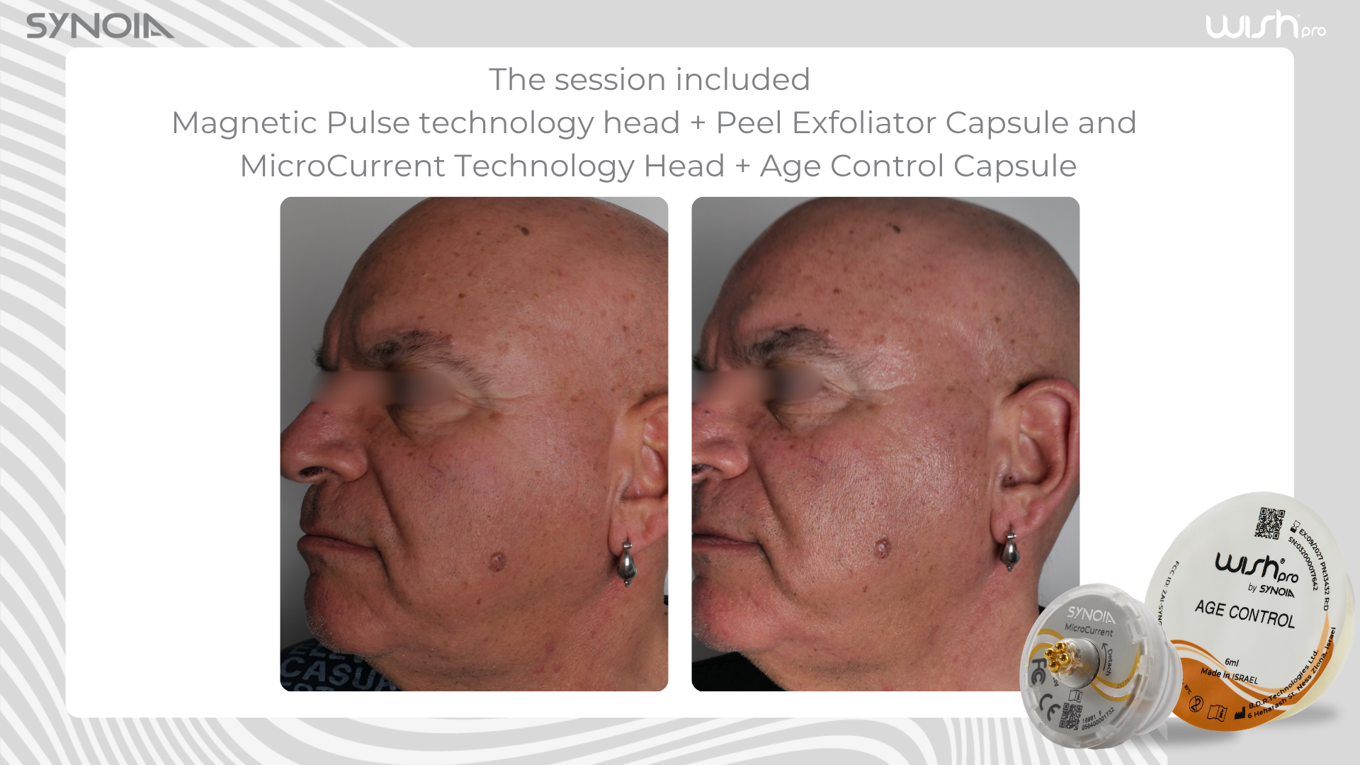 Before and after — Magnetic Pulse + Peel Exfoliator and MicroCurrent + Age Control Capsule