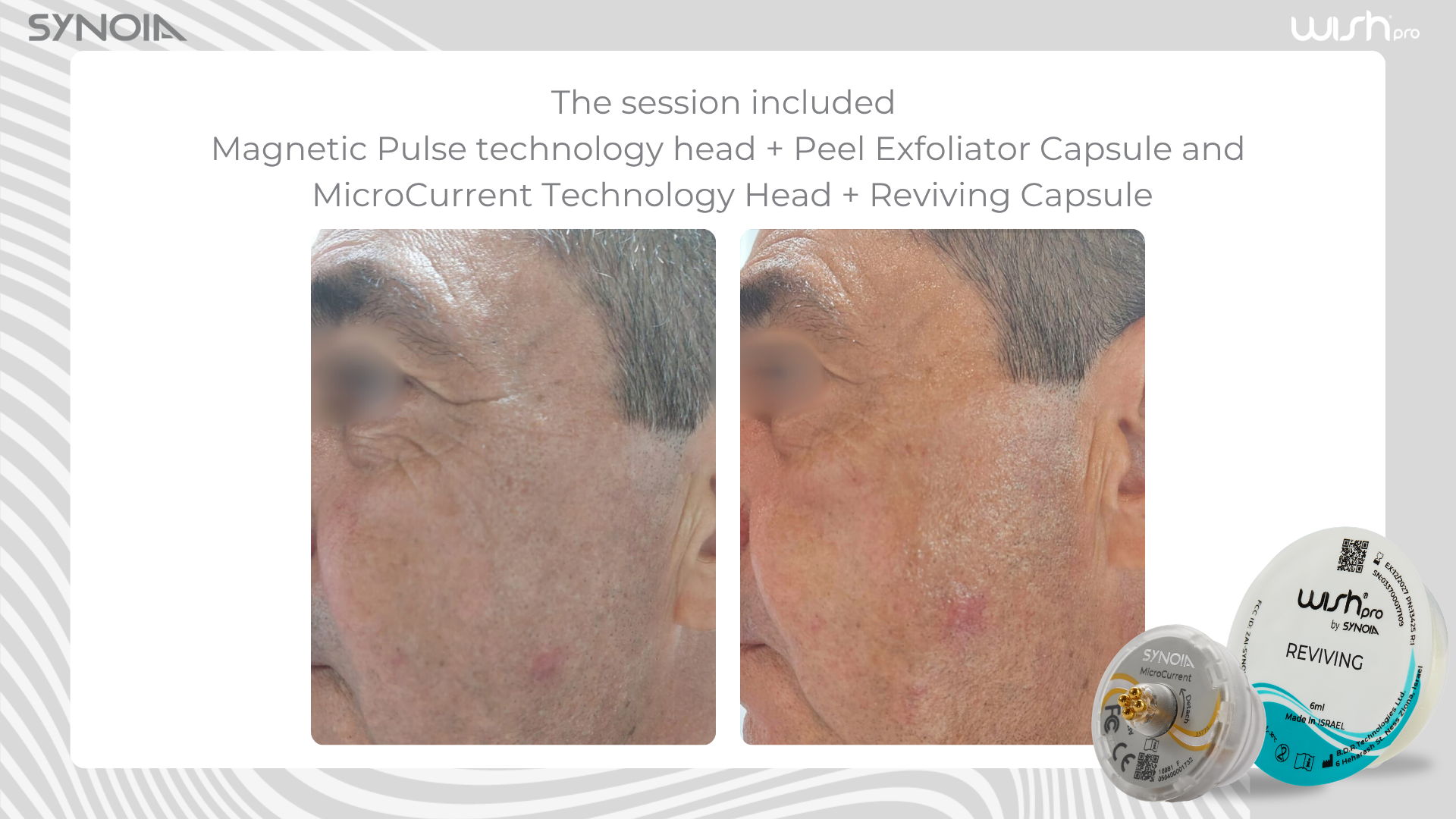 Before and after — Magnetic Pulse + Peel Exfoliator and MicroCurrent + Reviving Capsule