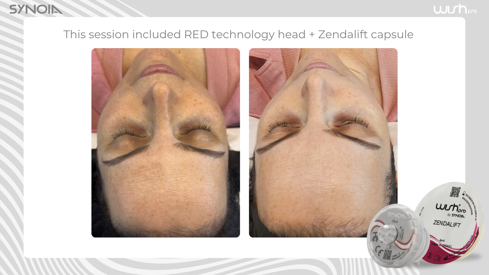 Before and after — RED Technology Head + Zendalift Capsule