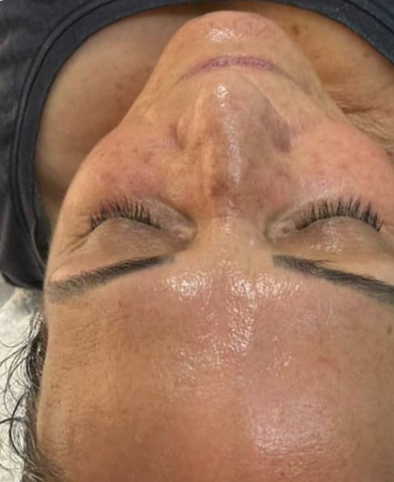 The same client's forehead after a WISHPro session