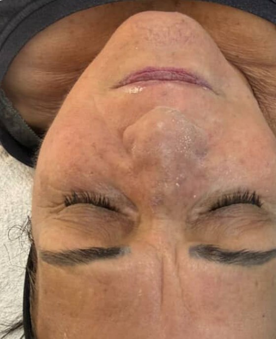 Client's forehead before a WISHPro session