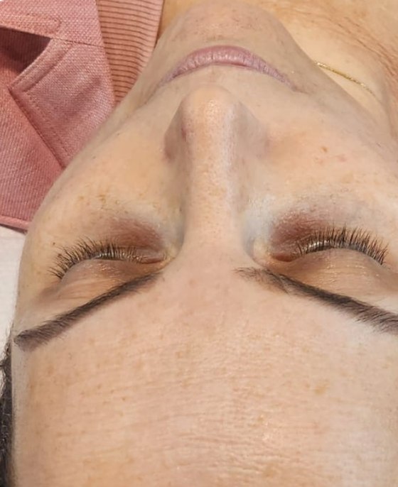 The same client's forehead and brow after a WISHPro session