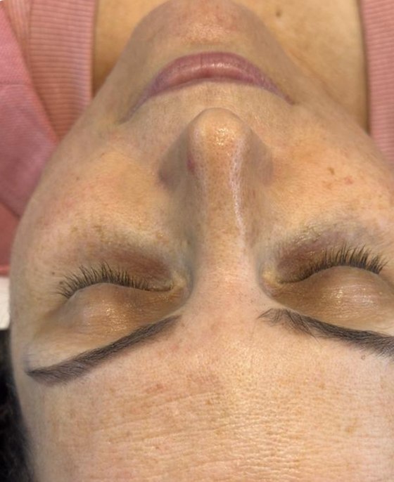 Client's forehead and brow before a WISHPro session