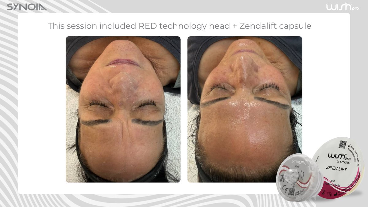 Before and after a WISHPro session using the Red Pro technology head with the Zendalift capsule
