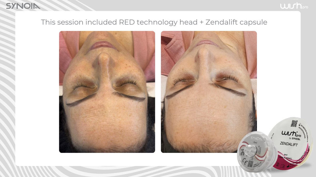 Before and after a WISHPro session using the Red Pro technology head with the Zendalift capsule