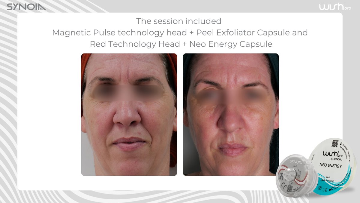 Before and after a WISHPro session using the Aqua Pro head with the Peel Exfoliator capsule, followed by the Red Pro head with the Neo Energy capsule