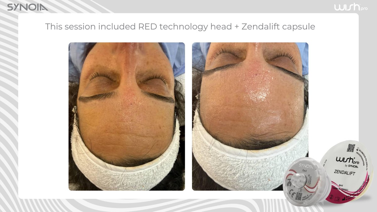 Before and after a WISHPro session using the Red Pro technology head with the Zendalift capsule